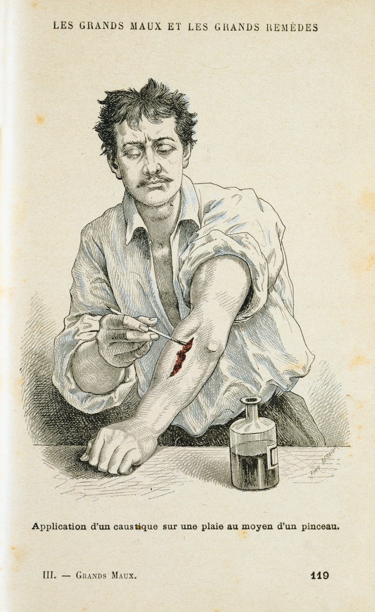 Sebfestés antiszeptikus oldattal, c1890 alkotó: Unbekannt