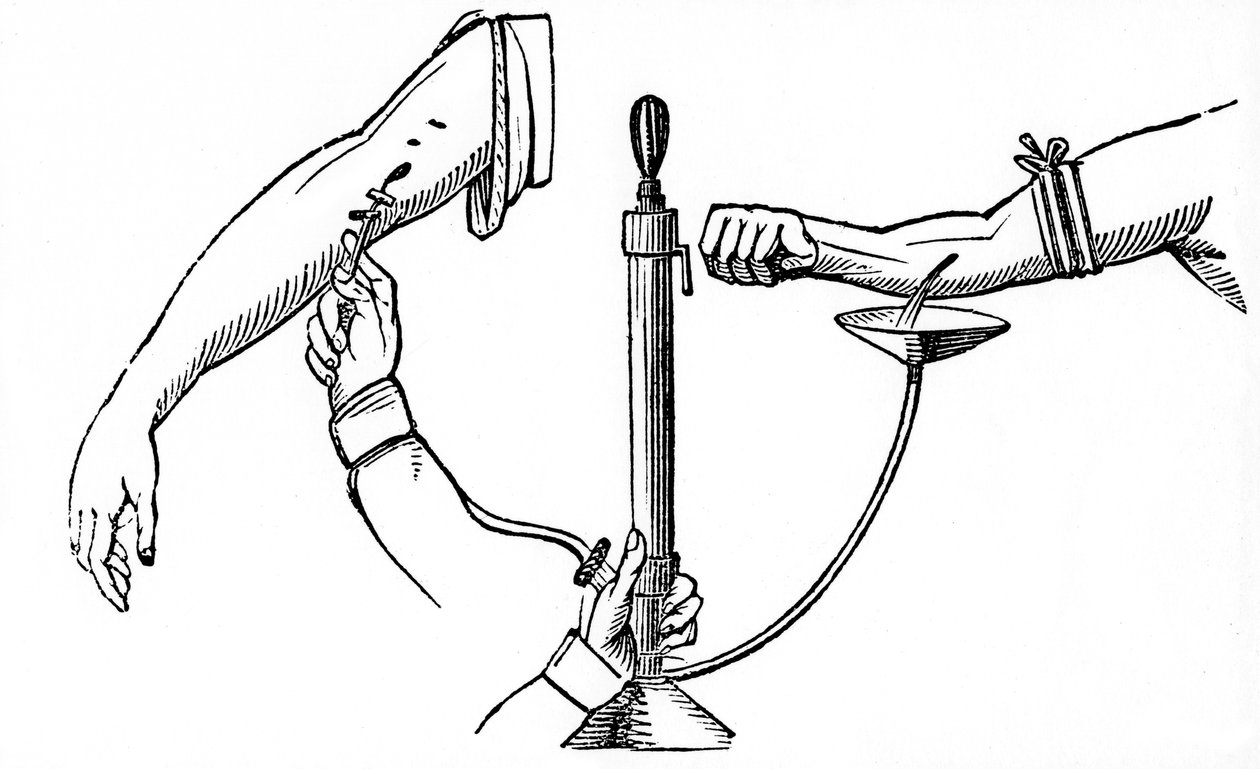 Személyes vérátömlesztés, 1833 alkotó: Unbekannt