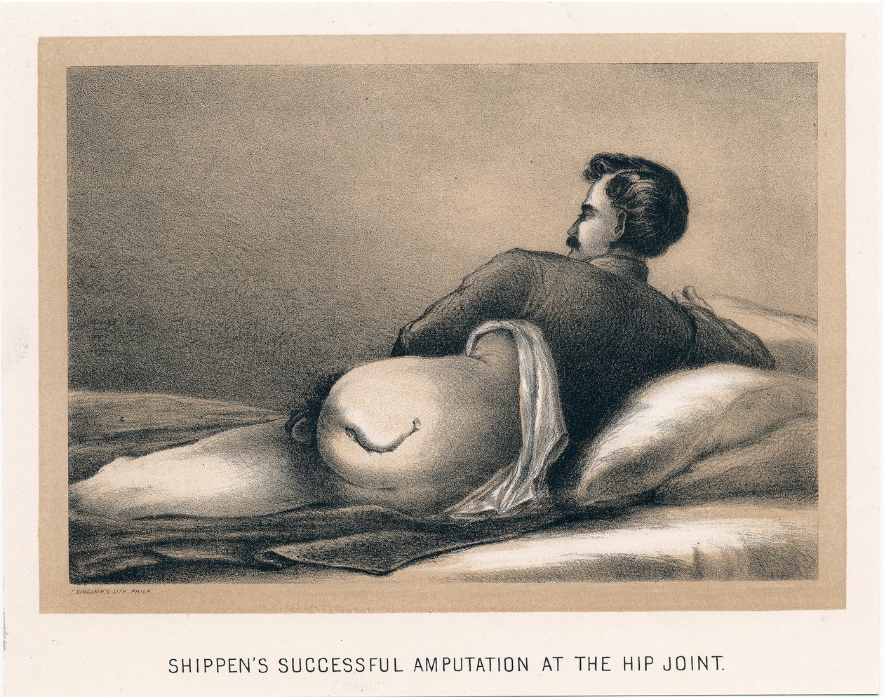 Shippens sikeres csípőízületi amputációja, amerikai polgárháború, 1865 alkotó: Unbekannt