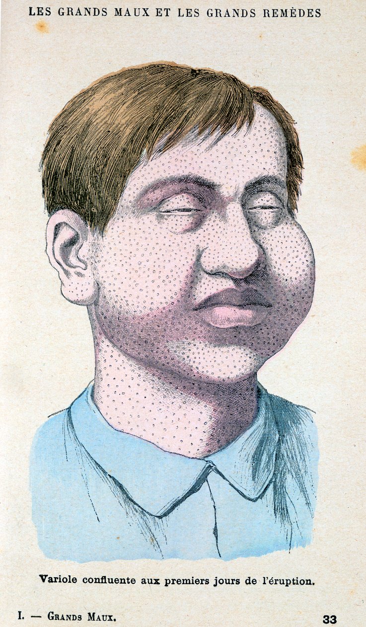 Himlő áldozata, 1890 alkotó: Unbekannt