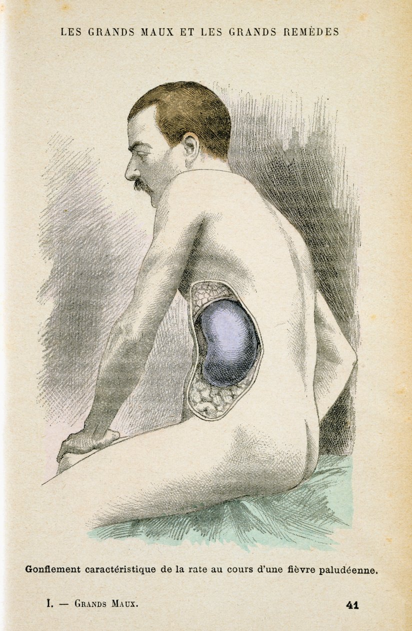 Tipikus megnagyobbodott lép egy maláriás betegnél, c1890 alkotó: Unbekannt