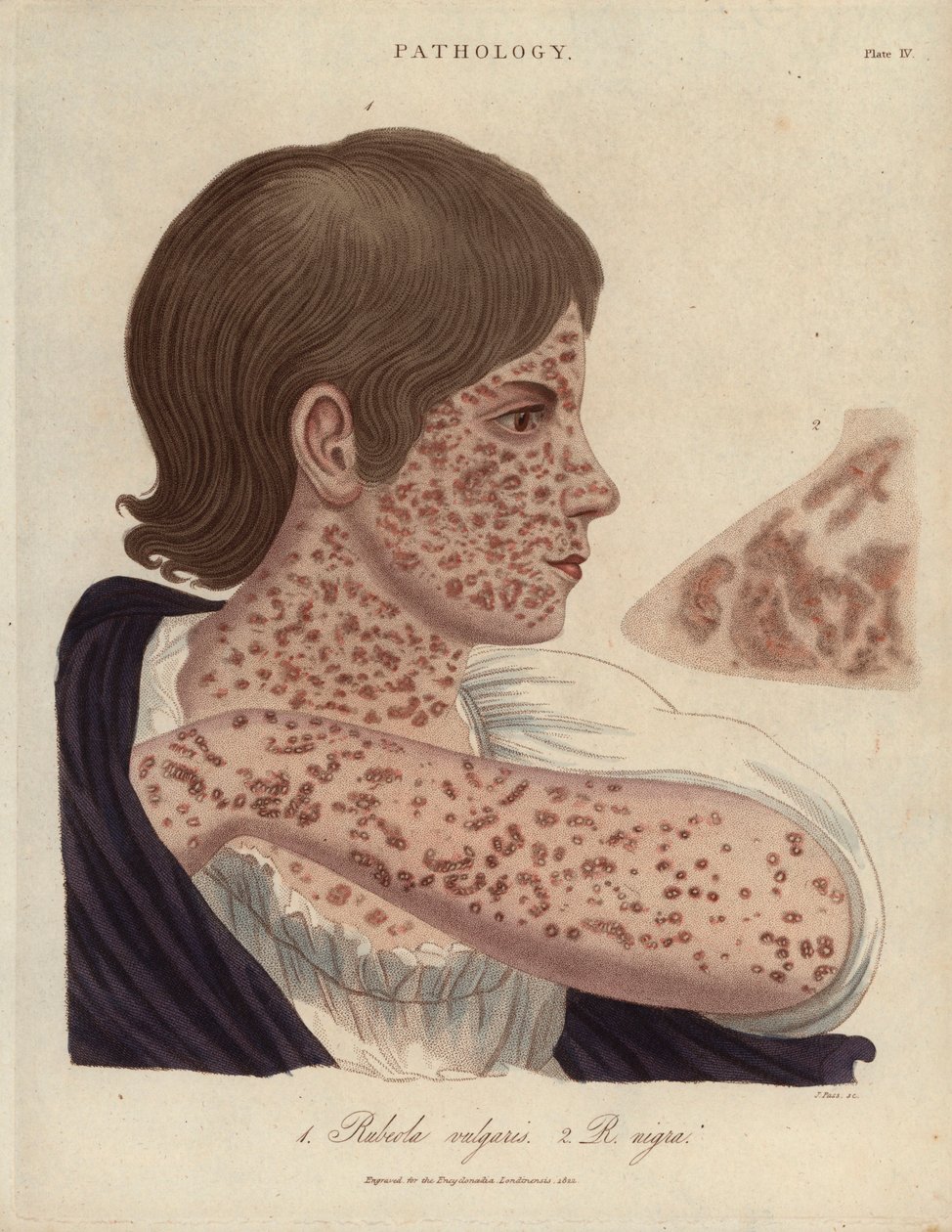 Measles and Rubeole - John Pass litográfiája, megjelent John Wilkes "Encyclopedia Londinensis" című könyvében, J.Adlard kiadásában, London. alkotó: Unbekannter Künstler