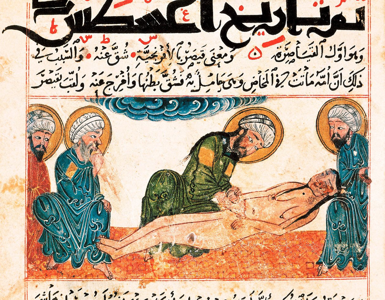 A császármetszés ábrázolása. Miniatűr Abu Raihan Al-Biruni (vagy Alberuni) (973-1048), perzsa értelmiségi és tudós orvosi kéziratából, 161. fólió. alkotó: Unbekannt