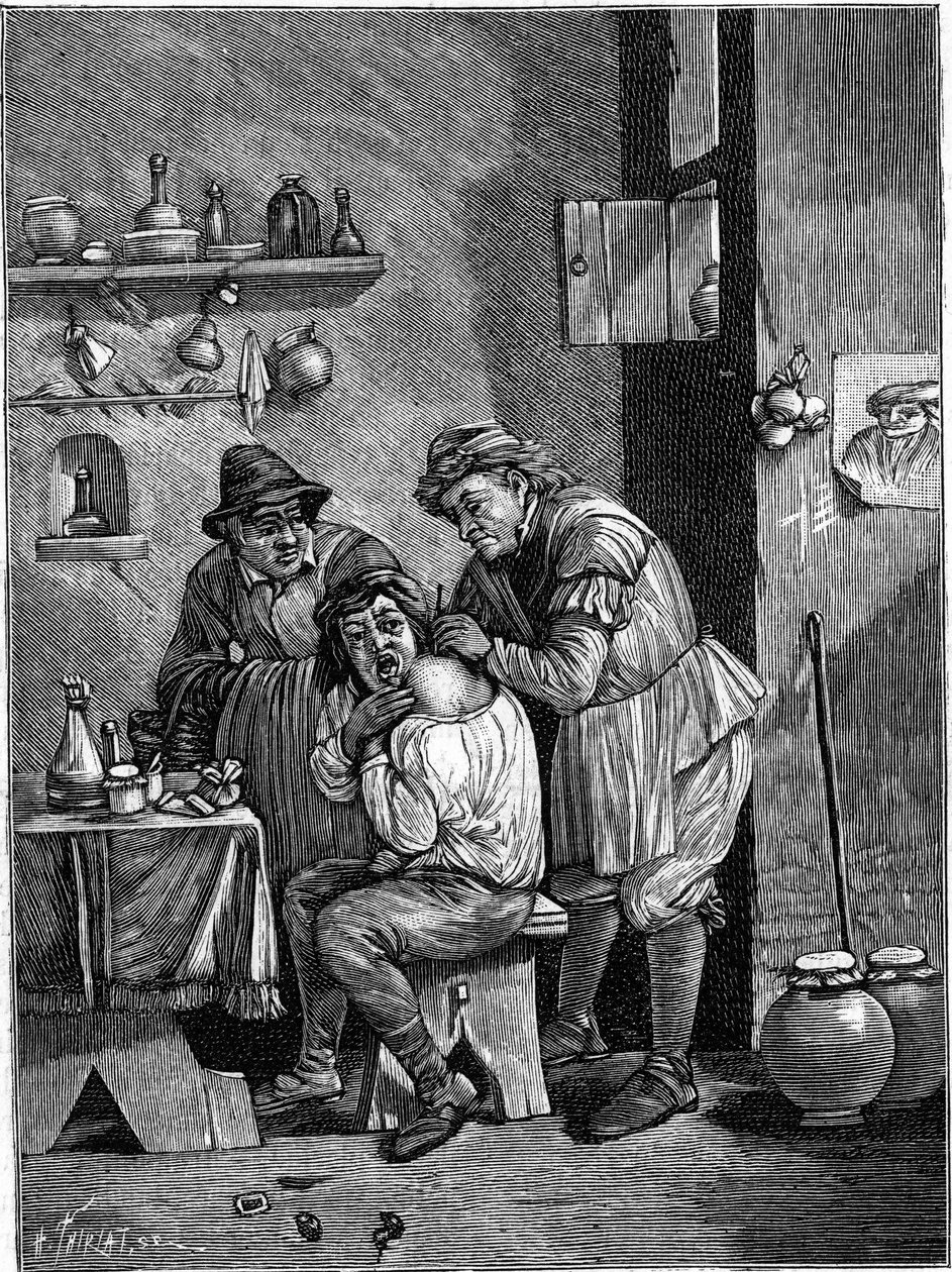 Egy sarlatán sebész a 18. században vállsérülést vizsgál. (Az idő metszetéből). Gravírozás: „” La Nature: revue des sciences et de leurs applications aux arts et a l
