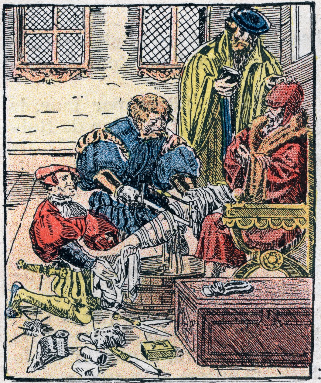 Láb amputációja a 16. században. alkotó: Unknown artist