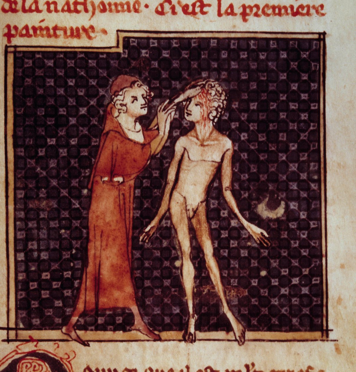 Anatómiai ábra: A sebész bemetszi a páciens homlokát. Miniatűr a „” Surgery” (Folio 8) kéziratból, amelyet Henri de Mondeville (Philippe Le Bel anatómiaprofesszor sebésze) írt. alkotó: Unknown artist