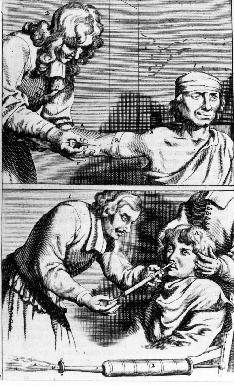 Vérzés és orrzuhany, Johannes Sculpteti „” Armamentarium Surgery”” Amszterdam 1672 alkotó: Unknown artist