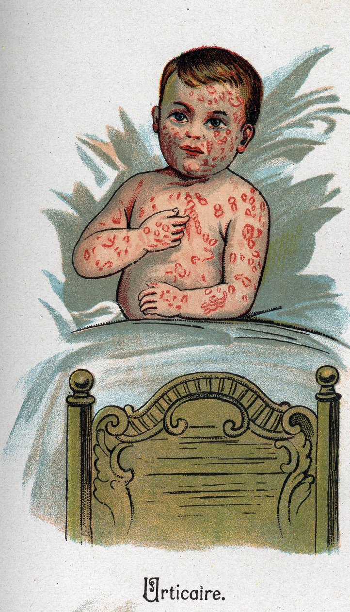 Gyermekbetegségek: csalánkiütés. F.E. Bilz „Az új természetgyógyászat” című könyvében. alkotó: Unknown artist