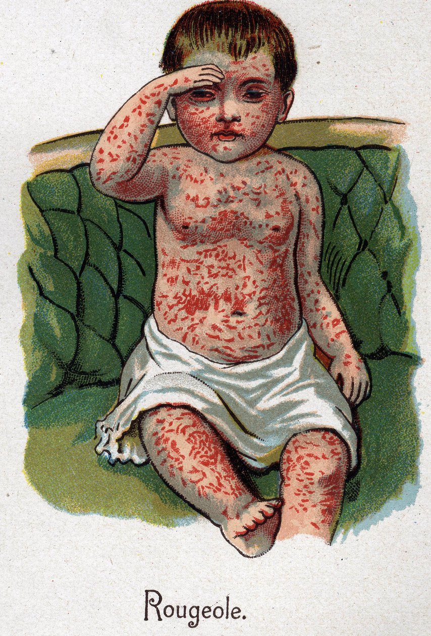 Gyermekbetegségek: kanyaró. F.E. Bilz „Az új természetgyógyászat” című könyvében. alkotó: Unknown artist