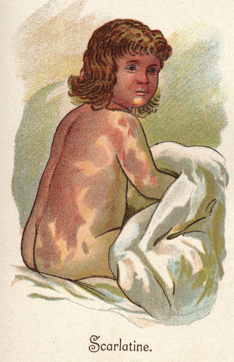 Gyermekbetegségek: skarlát. F.E. Bilz „Az új természetes gyógyszer” című könyvében. alkotó: Unknown artist