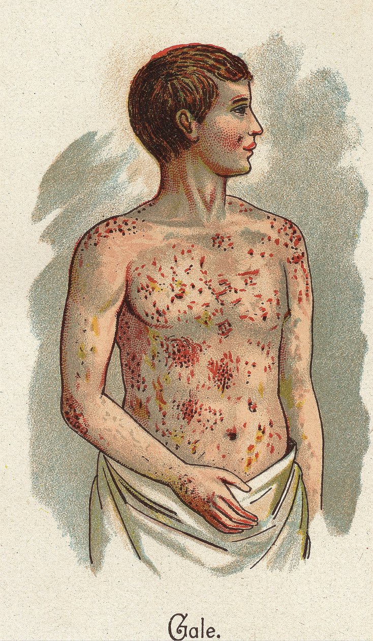 Gyermekbetegségek: A rüh. F.E. Bilz „Az új természetes gyógyszer” című könyvében. alkotó: Unknown artist
