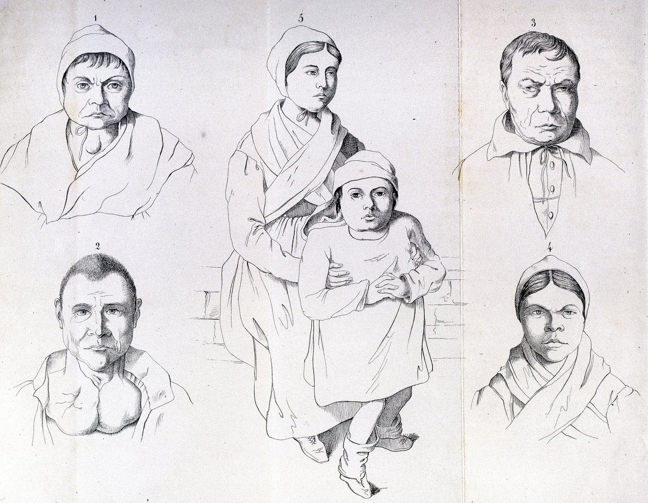 Morel megfontolások az endemikus kreténizmus okairól. alkotó: Unknown artist
