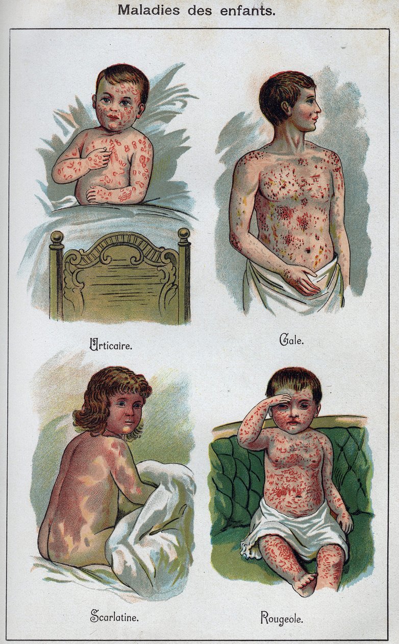 Gyermekek betegségei: csalánkiütés, kanyaró, rüh, skarlát. F.E. Bilz „Az új természetes gyógyszer” című könyvében. alkotó: Unknown artist