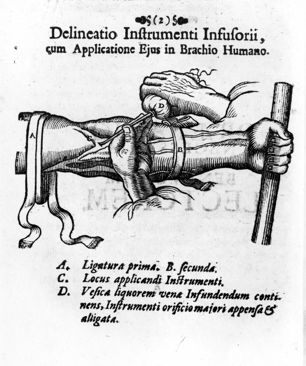 Intravénás injekció fürtös hólyag segítségével. J. D. Mayor, „” Surgery Infusoria”, Kilonii 1667 alkotó: Unknown artist
