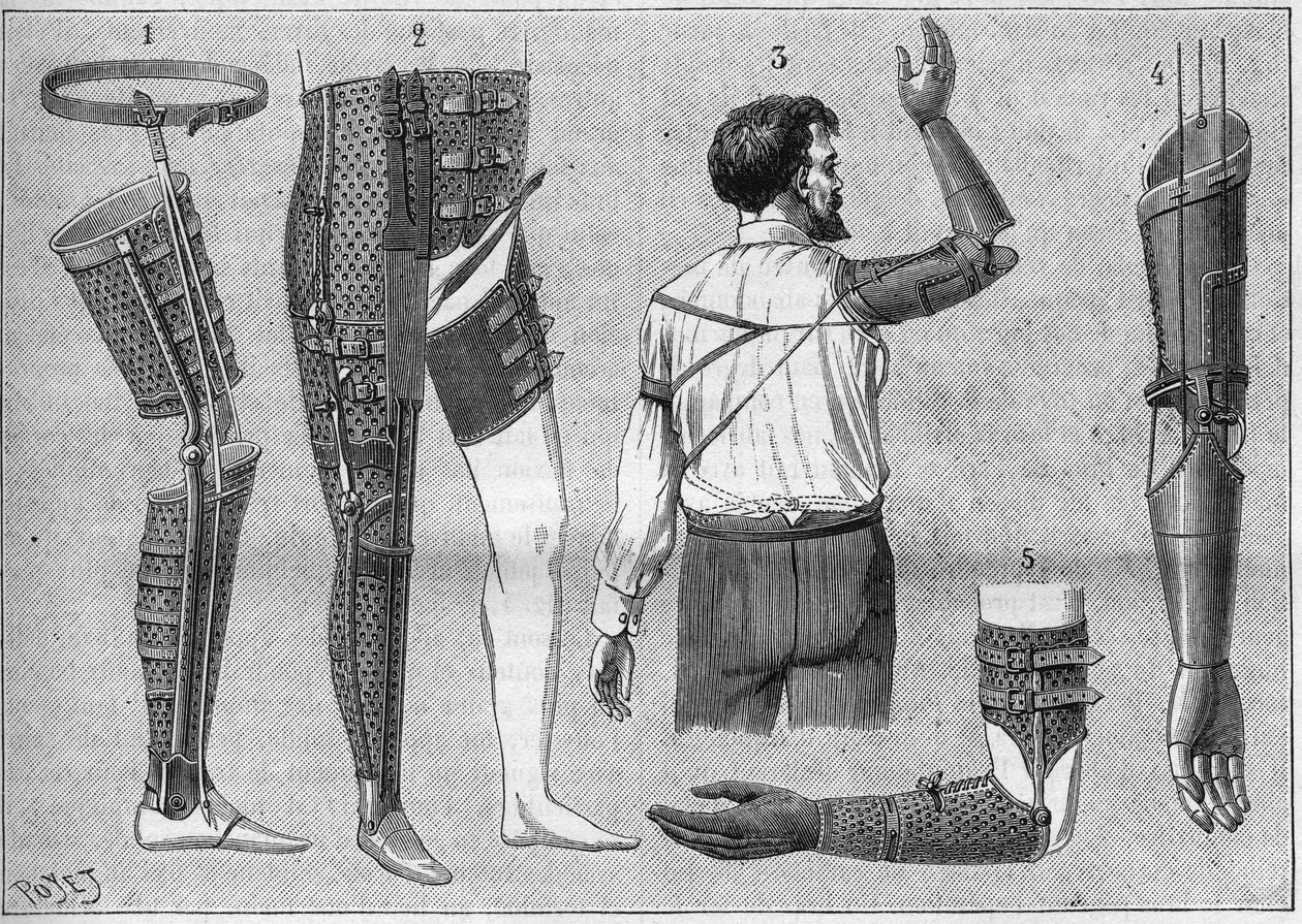 Modern készülék amputáshoz. 1) műláb övvel, 2) készülék a comb desarticulására, 3 és 4 mesterséges kar, amelyet M. L. Matthieu talált ki és épített a néhai Roger számára, 5) műkar kézzel, hüvelyk- és mutatóujjal. az 1888-as „La nature”-ban. alkotó: Unknown artist