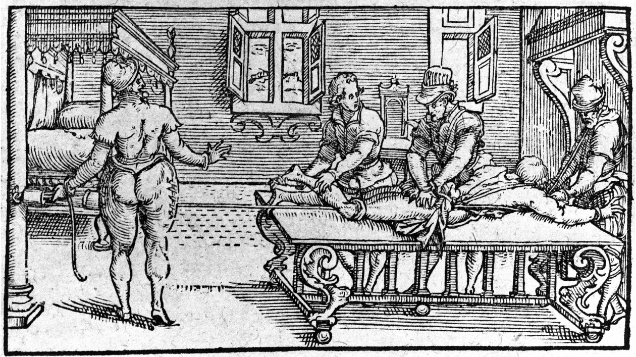 Elmozdulás csökkentése, Ambroise Paré „Traité Médical” című művében, 1560 körül. alkotó: Unknown artist
