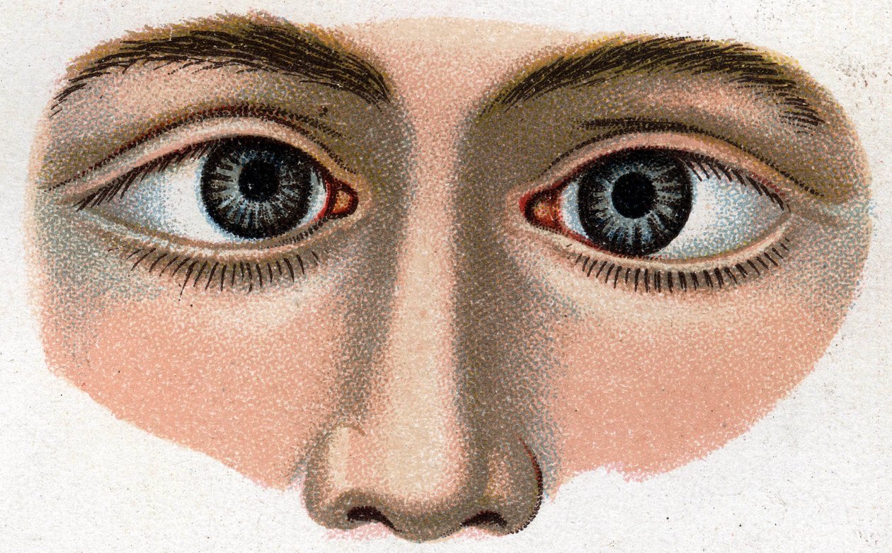 Strabismus konvergál. „Az új természetes gyógyszer”, F.E. Bilz. alkotó: Unknown artist