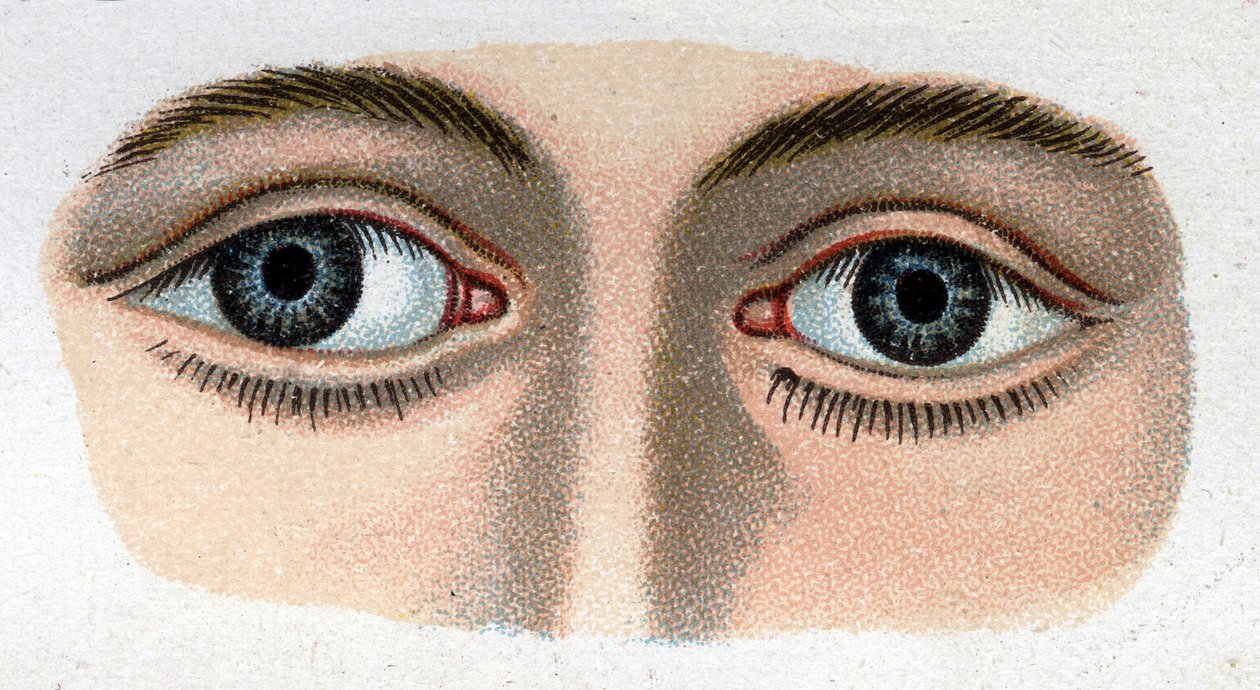 Strabismus divergens. „Az új természetes gyógyszer”, F.E. Bilz. alkotó: Unknown artist