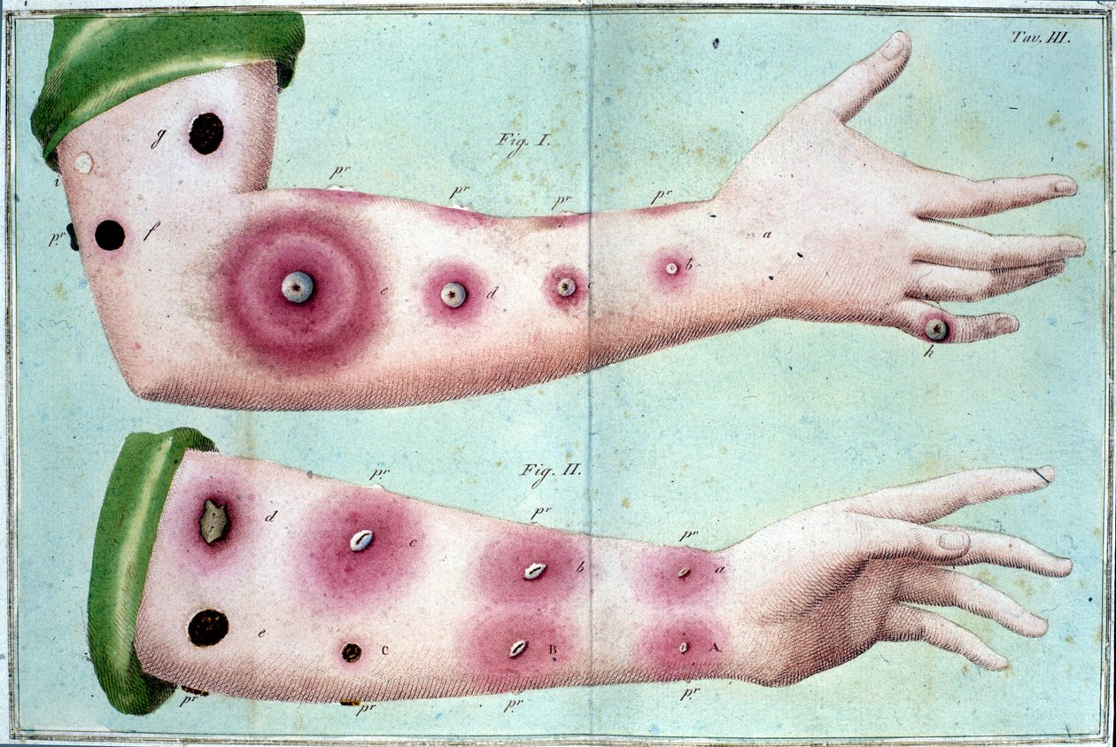 A himlőbetegség tünetei, amelyek pustulák kitörését okozzák a bőrön. Orvosi tányér a „” Vaccination Treat”-ből, Luigi Sacco, Milánó alkotó: Unknown artist