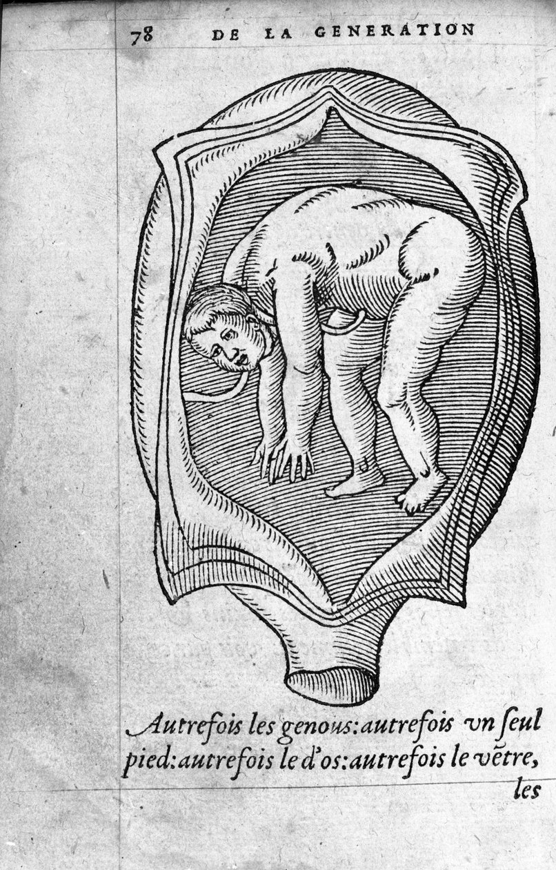 A magzat helyzete a méhben a terhesség alatt. Ambroise Pare francia orvos és sebész (1509-1590) „De la Generation des enfants” című metszete XVI. alkotó: Unknown artist