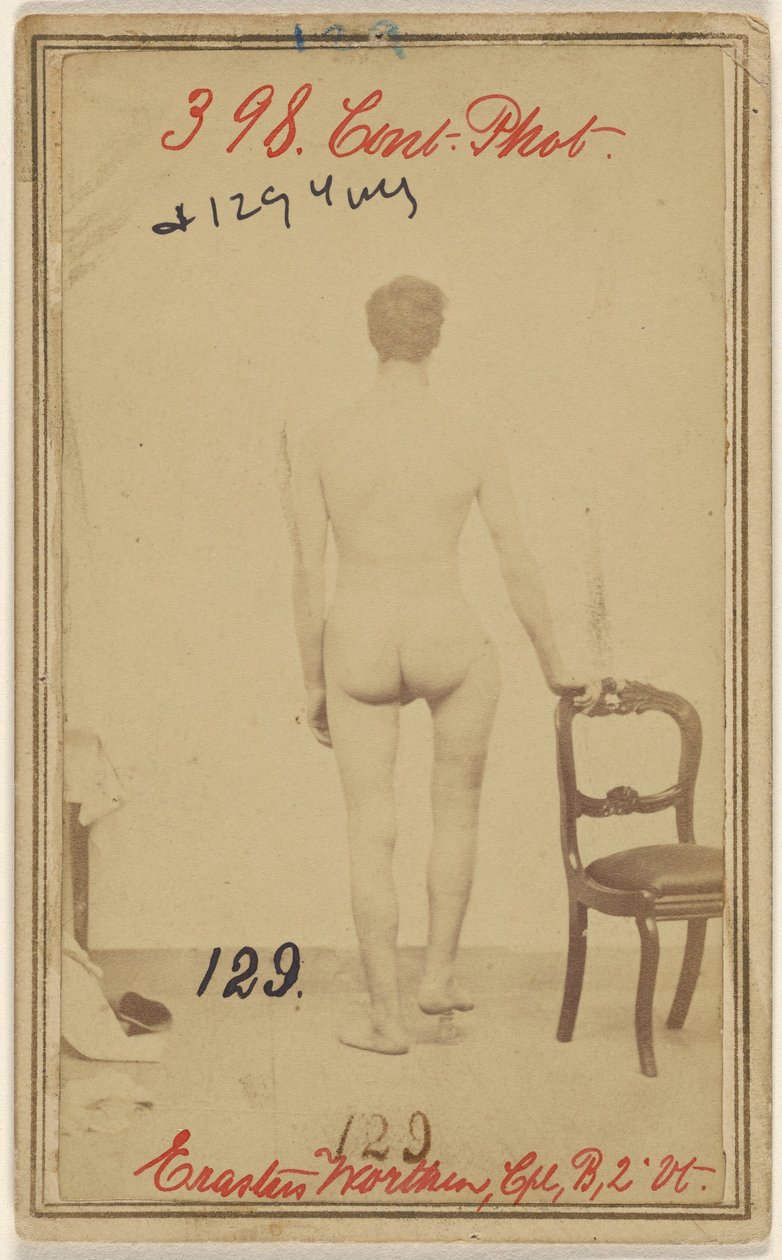 A combcsont felső harmadának törése. Erastus Worthen, Corp Co. B. 2. Vermont Vols. 25 éves - lakóhelye Stockbridge VT. alkotó: Unknown artist