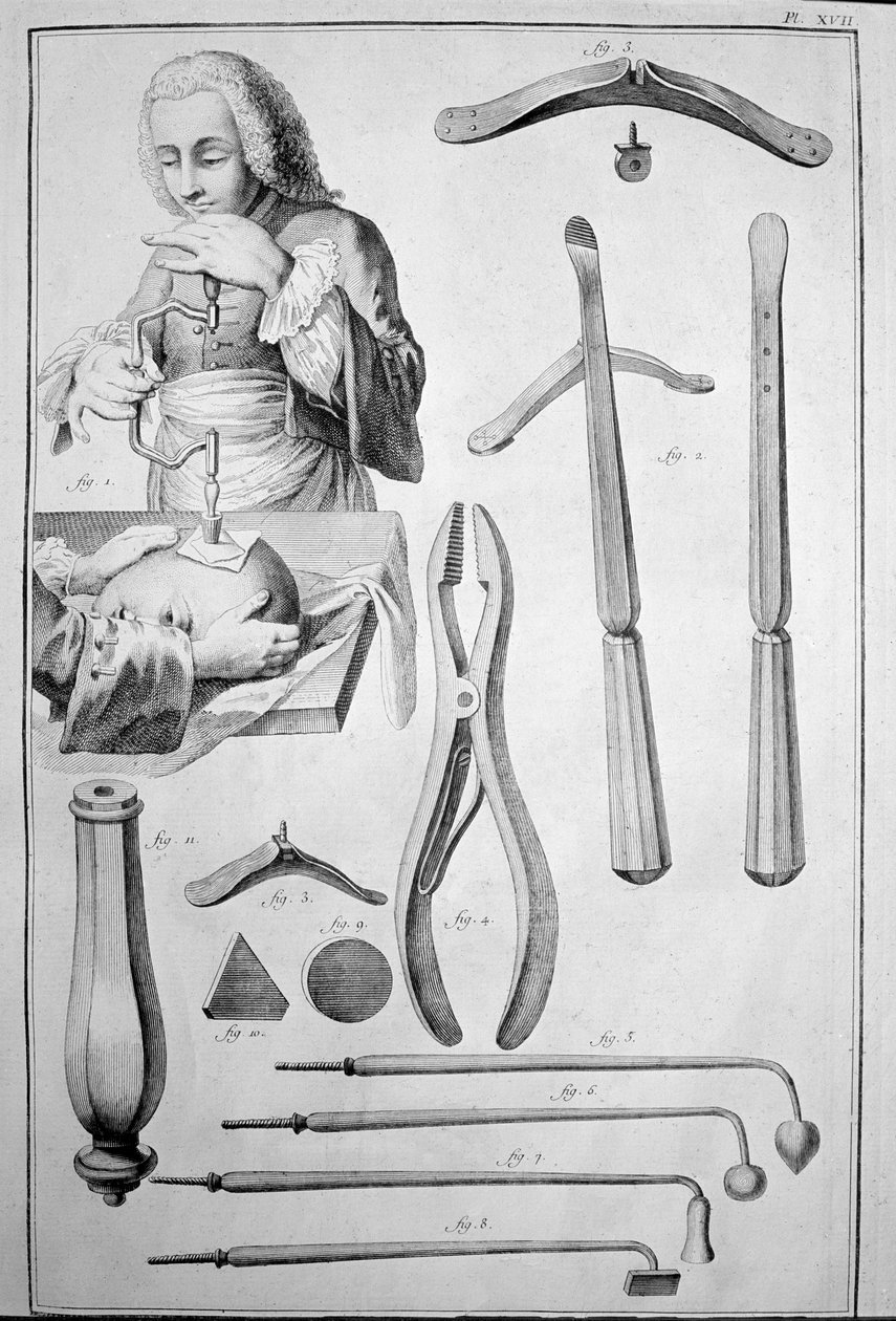 A koponya trepanációja, különféle eszközök (metszet alkotó: Unknown artist