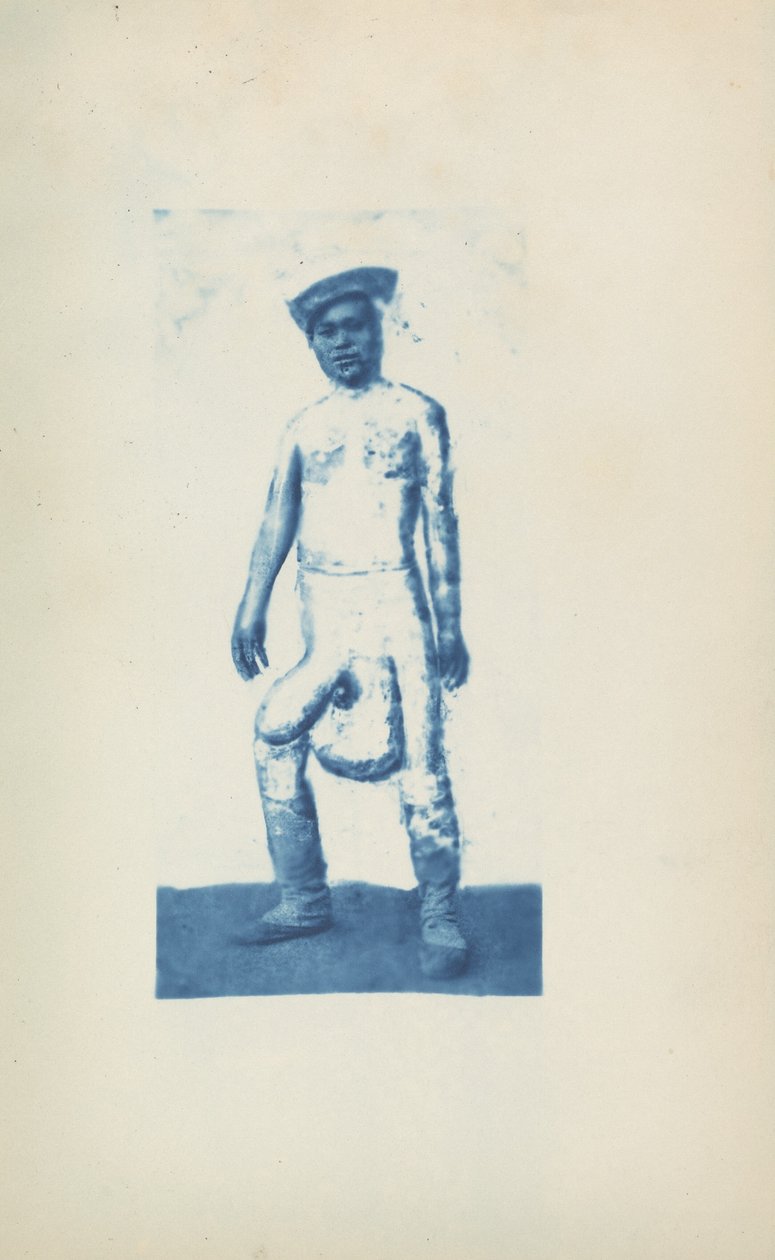 Elefantiázis,c. 1870-es évek (fotó) alkotó: Unknown photographer