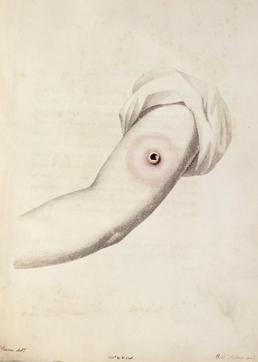 Tehénhimlő pustule a karon, Edward Jenner (1749-1823) „A Variolae Vaccinae okainak és következményeinek vizsgálata” című könyvéből, Pearce metszete, 1800 körül alkotó: William Skelton