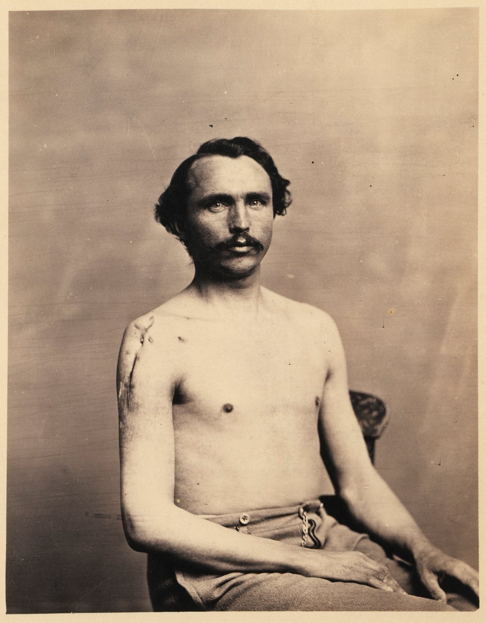 Adolph Zirsse közlegény, a jobb humerusz fejének és a jobb humerusz szárának két és fél hüvelyknyi részének sikeres köztes eltávolítása, a Sebészeti Szekció fényképészeti katalógusából. alkotó: William Bell