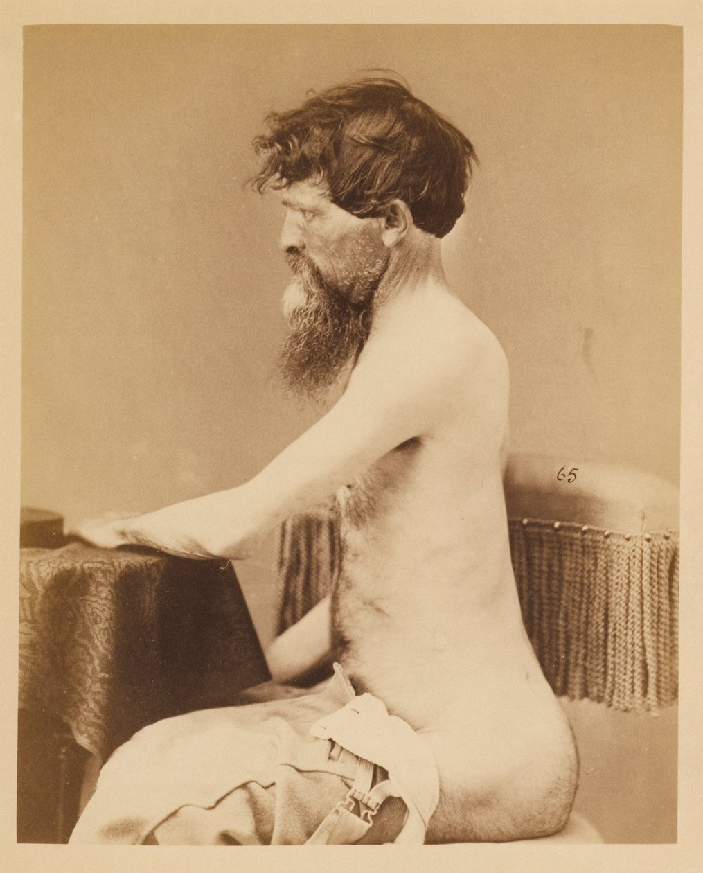 John Bar közlegény, felépülés egy hasi áthatoló seb után, a bal oldali Os Innominatum törésével, a Sebészeti Szekció fényképkatalógusából. alkotó: William Bell