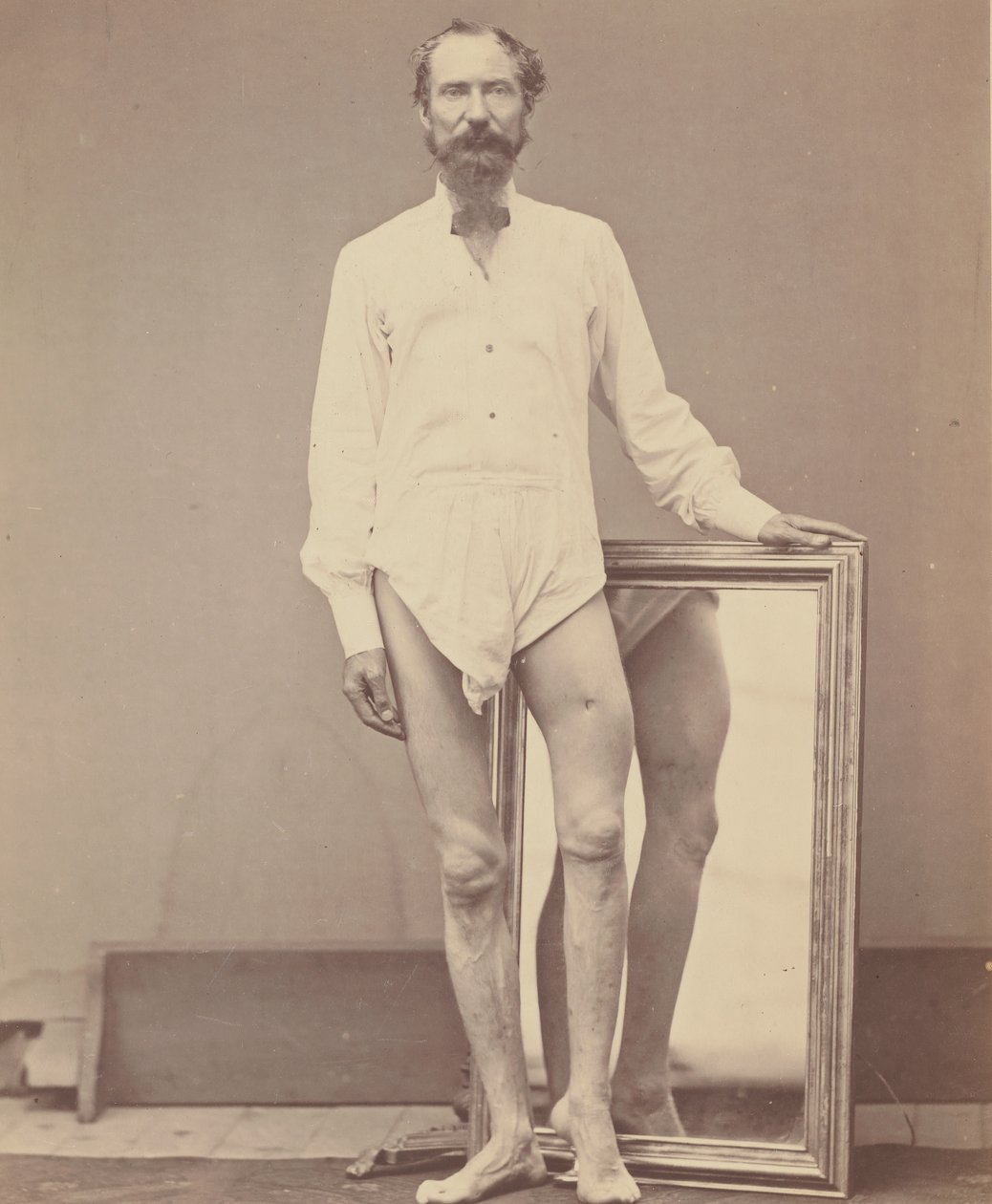 A bal combcsont középső harmadának lőtt sebe, 1865-67. alkotó: William H. Bell