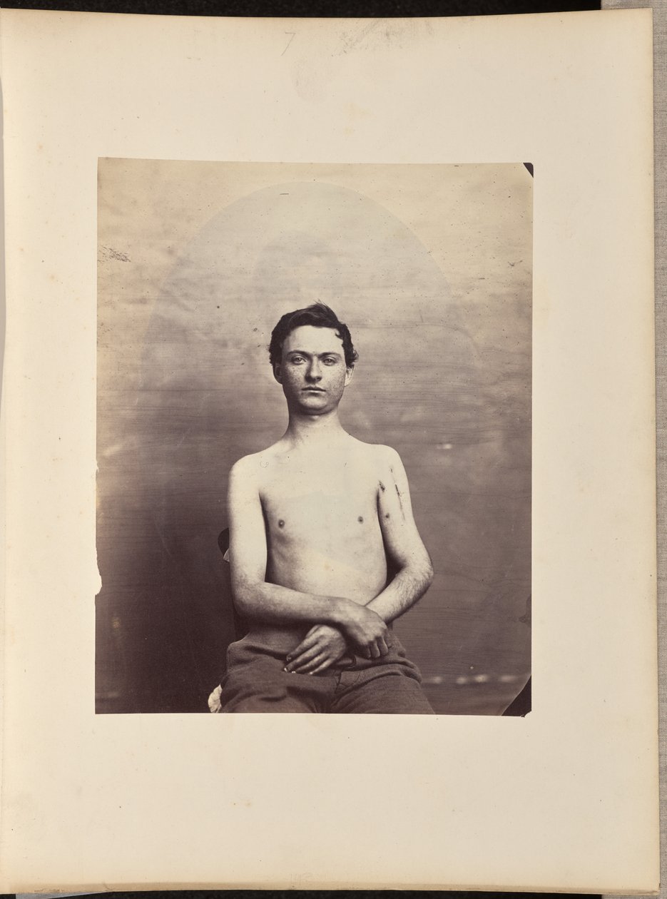 Helyreállítás a bal humerusz fejének eltávolítása után lőtt törés esetén alkotó: William H. Bell