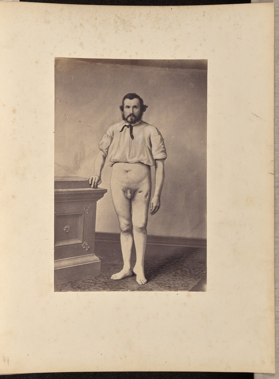 A bal combcsont fejének sikeres kimetszése lőtt törés esetén alkotó: William H. Bell