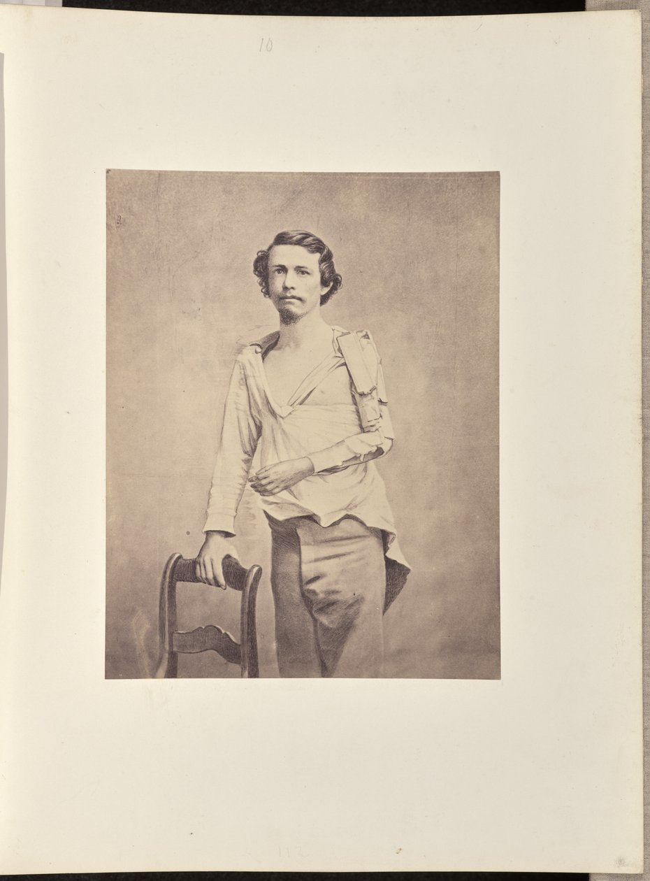 A bal oldali humerusz fejének sikeres kimetszése, majd a humerusz és a radius és az ulna felső végtagjainak nekrózisa és másodlagos kimetszése. alkotó: William H. Bell