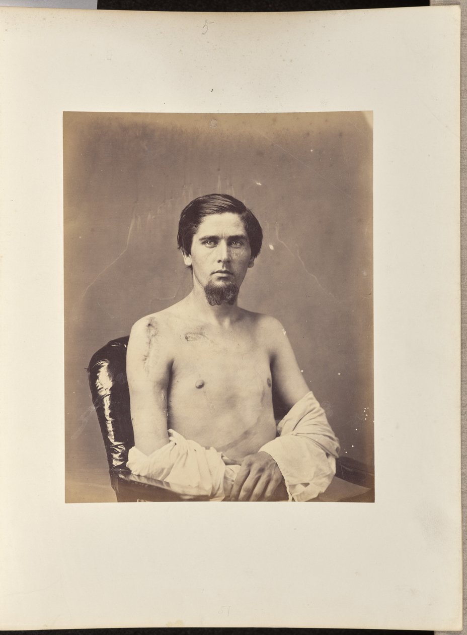 Sikeres kimetszése a jobb humerus fejének alkotó: William H. Bell
