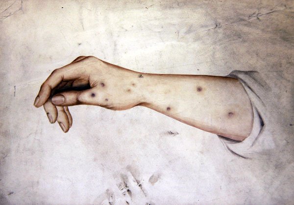 Egy alkar vizsgálata bőrbetegséggel, 1850 körül (akvarell papíron) alkotó: William Lover