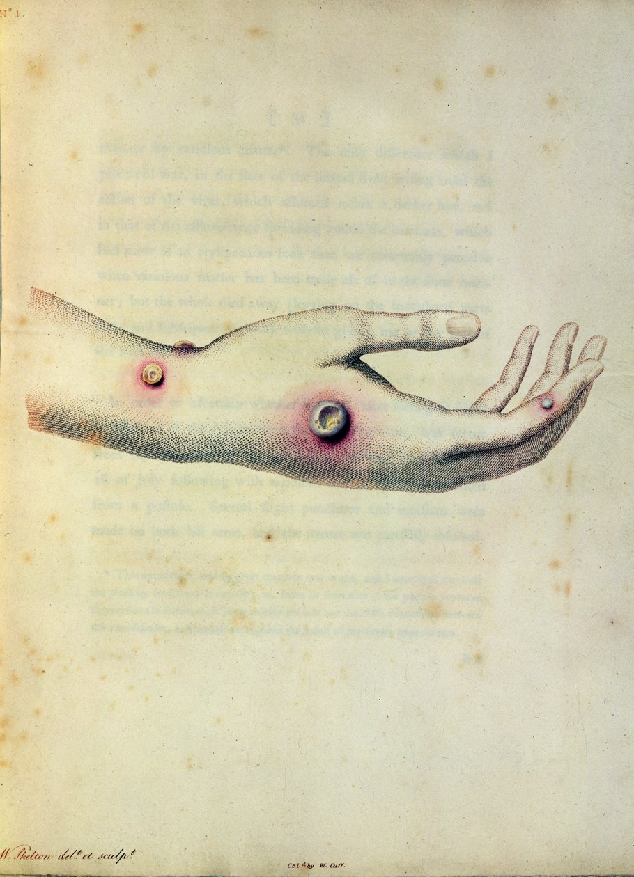 Tehénhimlő pustule Sarah Nelmes karján, Edward Jenner (1749-1823) „A Variolae Vaccinae okainak és következményeinek vizsgálata” című könyvéből, Pearce metszetében, 1800 körül alkotó: William Skelton