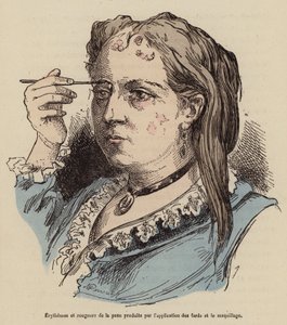 Nő a smink használatából eredő bőrkiütésekkel és bőrpírral (színes metszet) alkotó: (after) French School