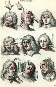 Sebészet a 18. században: A szem és az arc trepanációja, műtétje. Metszet Lorenz Heister „Institutions chirurgicale”-ba alkotó: Anonymous Anonymous