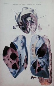 A szív és a tüdő apoplexiája, Jean Cruveilhier (1791-1874) „Anatomie pathologique du corps humain” című művének illusztrációja, Párizsban megjelent