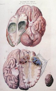 Az agy rákos daganatai Jean Cruveilhier (1791-1874) 1828-42-es "Anatomie Pathologique du Corps Humain" című művéből (színes metszet).