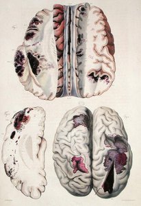 Kapilláris apoplexia, Jean Cruveilhier (1791-1874) „Anatomie Pathologique du Corps Humain” című művéből, 1828-42 (színes metszet)