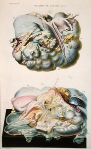 Petefészek betegségei, Jean Cruveilhier (1791-1874) „Anatomie Pathologique du Corps Humain” című művéből, 1828-42 (színes metszet)