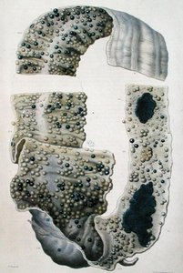 Bélbetegségek, Jean Cruveilhier (1791-1874) „Anatomie Pathologique du Corps Humain” című művéből, 1828-42 (színes metszet) alkotó: Antoine Chazal