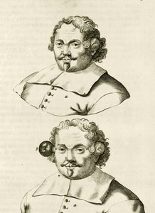 Egy példa a köpölyözésre, Frederik Dekkers The Practice of Medicine című könyvéből, 1694 alkotó: Dutch School