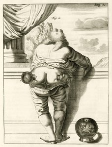 Egy példa a köpölyözésre, Frederik Dekkers The Practice of Medicine című könyvéből, 1694 alkotó: Dutch School