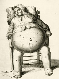 Folyadékleeresztés egy tályogból Frederik Dekkers, 1694 alkotó: Dutch School