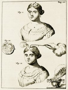 Epilepsziában szenvedő betegek kezelése Frederik Dekkers gyakorlataiból az orvosi gyakorlatban, 1694 alkotó: Dutch School