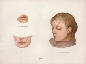 Bőrbetegségek: herpesz (színes litho) alkotó: English School