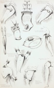 A vérzés megállításának módszerei, 1890 körül alkotó: English School